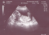Baby-17W
